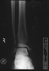 KnoechelFussRechtsFrontalOpt03