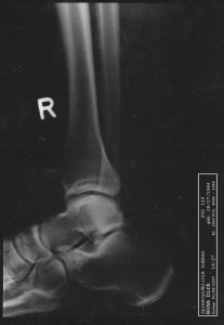 KnoechelFussRechtsSeiteOpt05 KnoechelFussRechtsSeiteOpt05